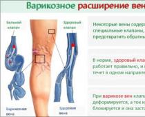 Отсрочка после операции или берут ли в армию с варикоцеле?